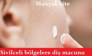 diş macunu sivilcelere iyi gelir