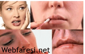 uçık tedavisi